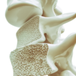 Osteoporose